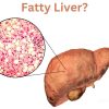 dietfind fatty liver 1