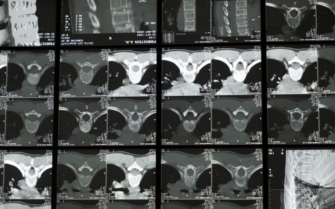 The Importance of Early Screening for Bone Density