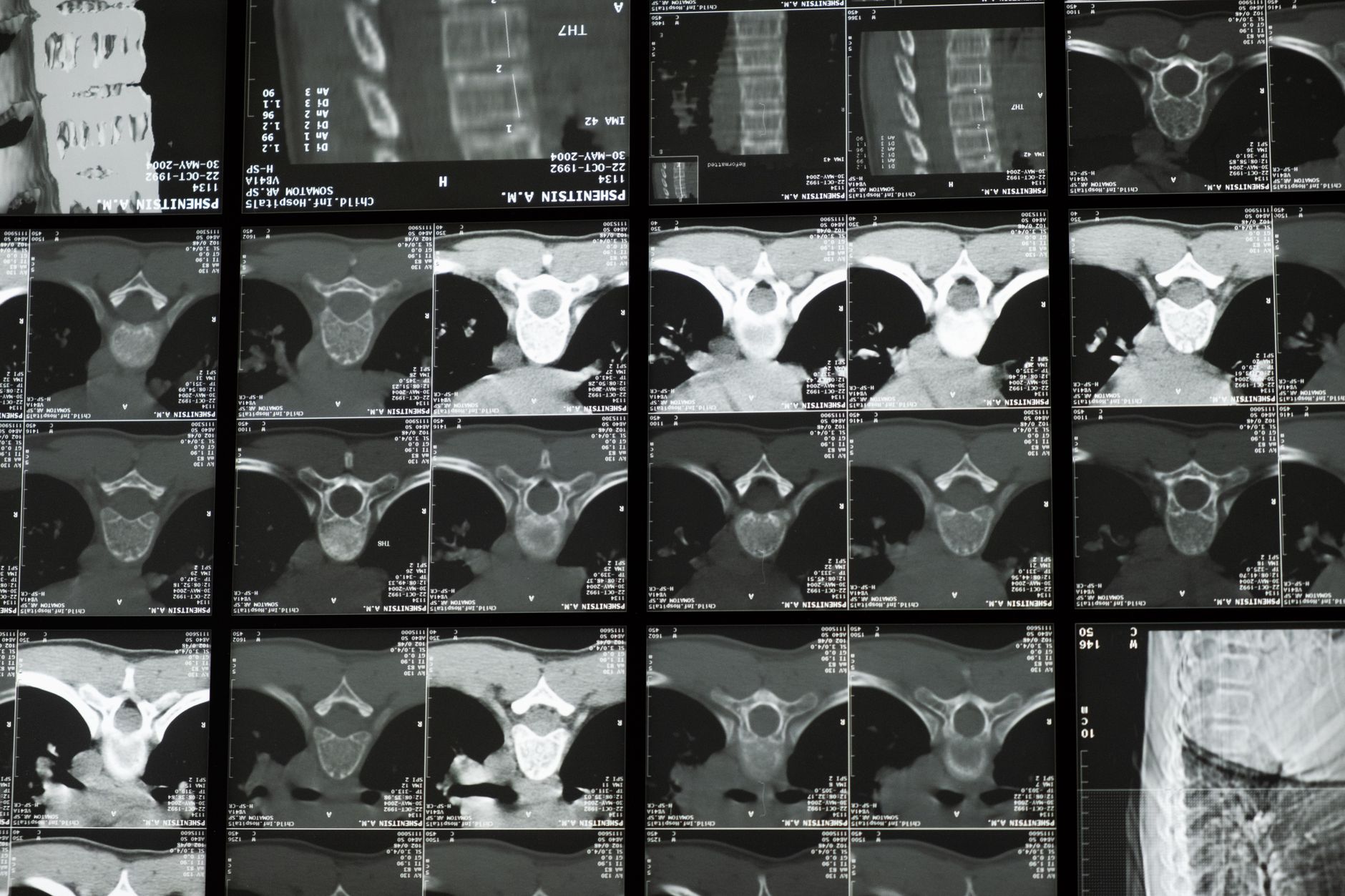 Radiological X-ray images of the human spine used in bone density medical examination